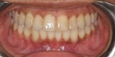 Braces-After