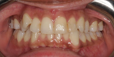 Braces-Before