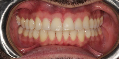 Ortho1-Before