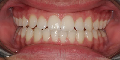 Rectracted-After