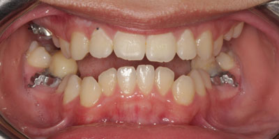 Retracted-Before
