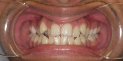 Retracted2-Before
