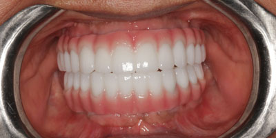Retracted3-After