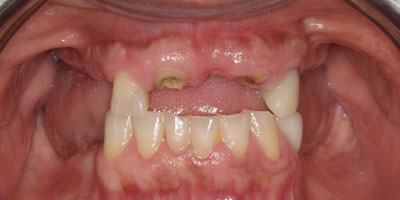 Retracted3-Before