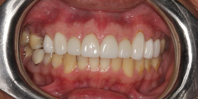 Retracted4-After