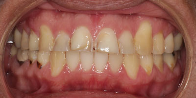 Retracted4-Before