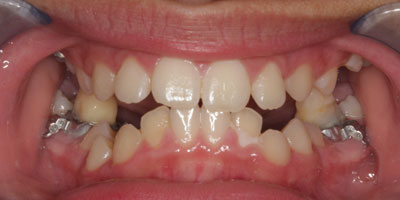 Smile1-After
