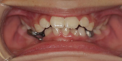 Smile1-Before