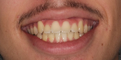 Smile2-After
