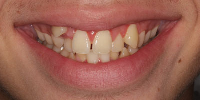 Smile2-Before