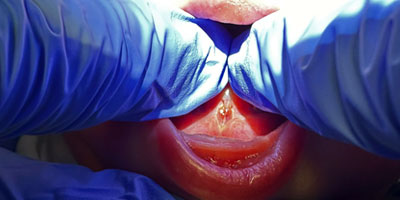 Tounge1-After