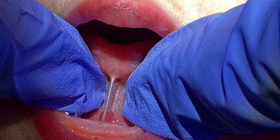 Tounge1-Before