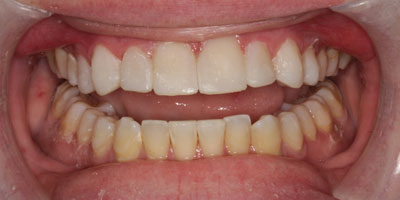 Veneers1-After