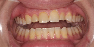 Veneers1-Before
